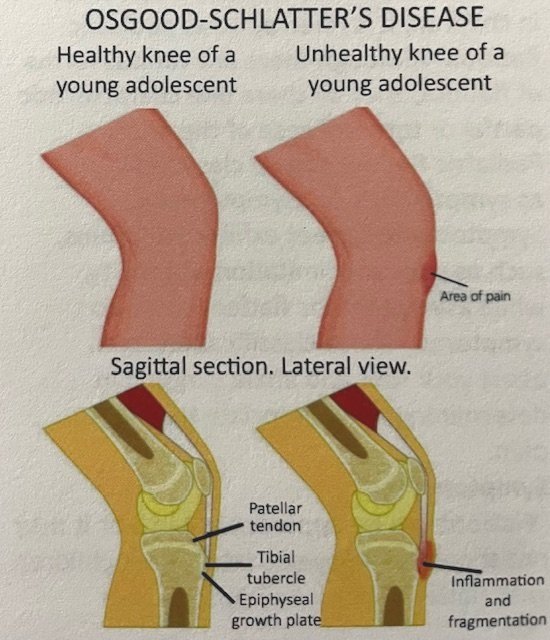 child knee pain osgood schlatter knee