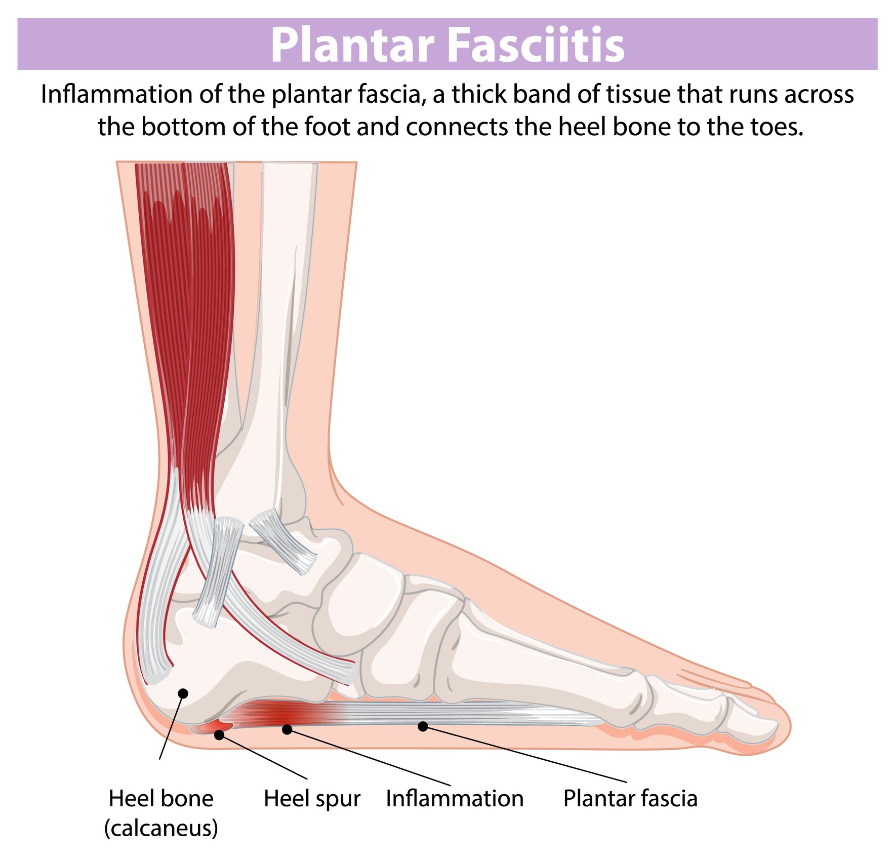 heel pain 01