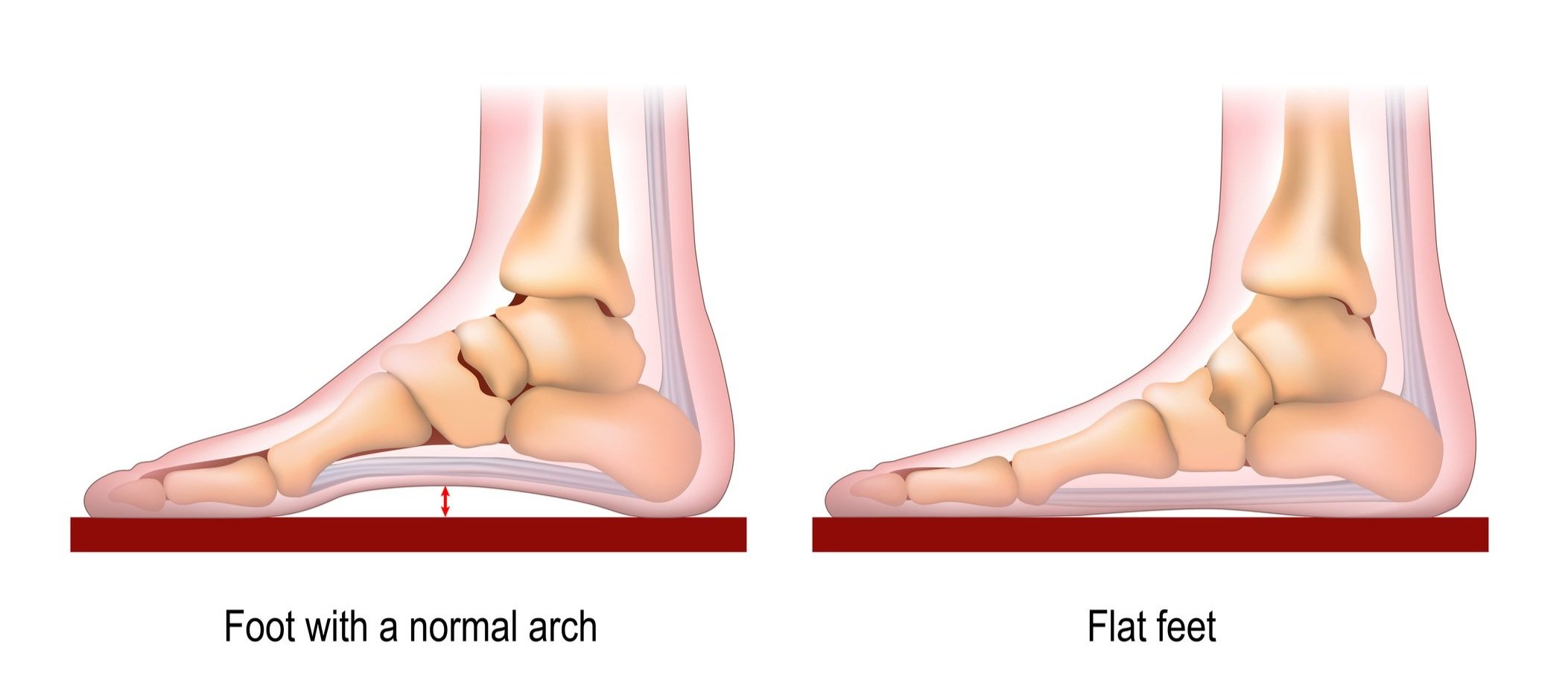 poor posture Normalvsabnormalfootarch